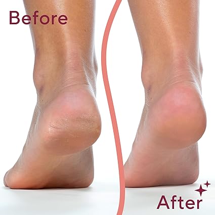 Feet Pedicure Device- Callus Remover