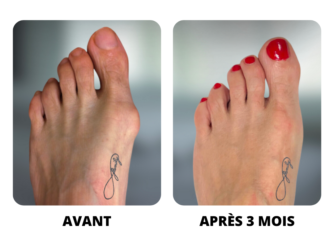 Toe bunion corrector-Hallux Valgus Correction
