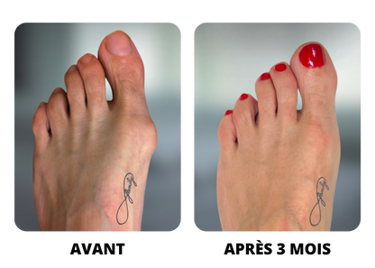 Toe bunion corrector-Hallux Valgus Correction